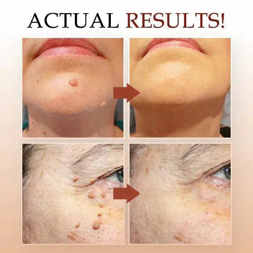 Warts & Moles Remover Pen (GUARNTEED RESULT)